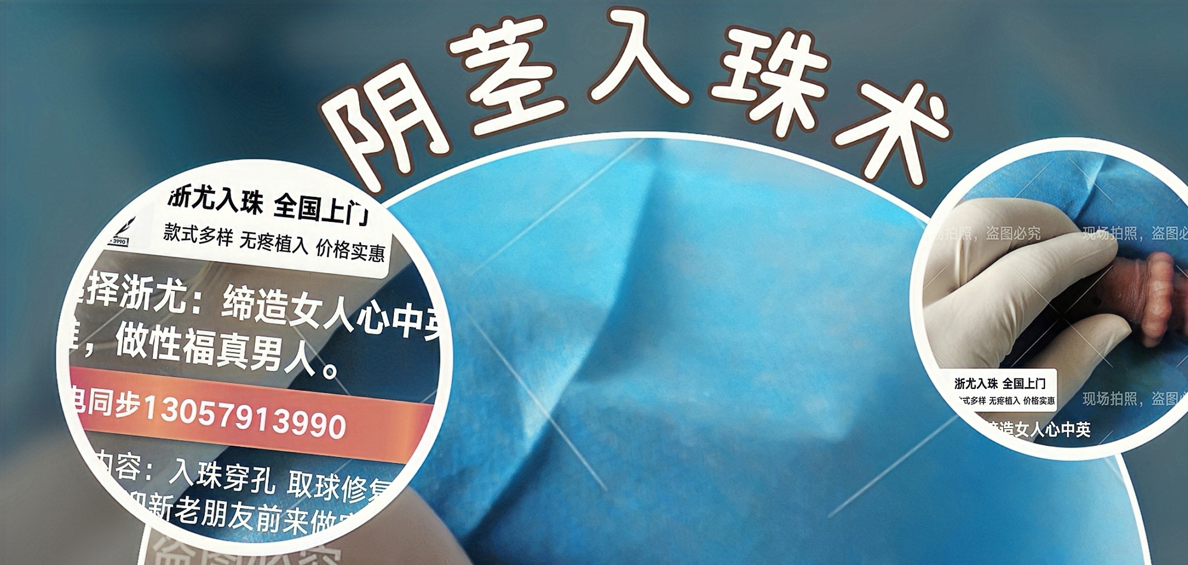 男士埋珠手術醫(yī)院，探索與理解，男士埋珠手術醫(yī)院，深入了解與探索