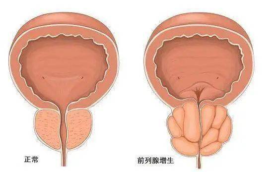 前列腺鈣化，一種常見的前列腺疾病及其相關(guān)知識(shí)解析，前列腺鈣化解析，常見疾病與相關(guān)知識(shí)探討
