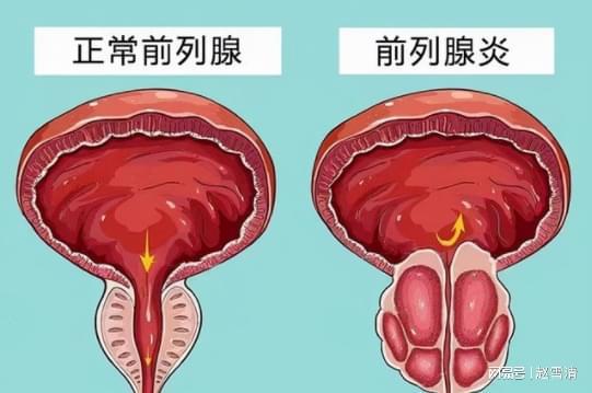 男性前列腺炎的癥狀解析，男性前列腺炎的癥狀詳解