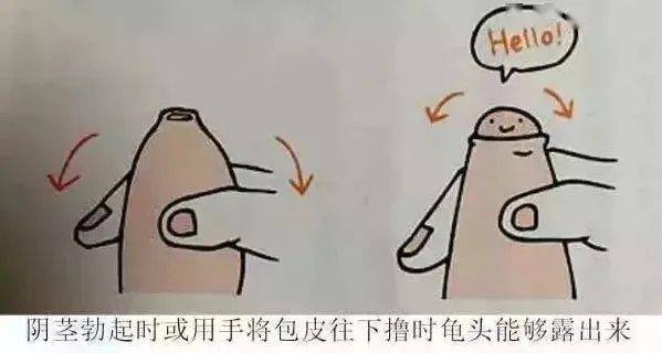 割包皮后需要注意的事項(xiàng)及用嘴巴是否可行，割包皮后注意事項(xiàng)詳解，口腔操作不可行，護(hù)理要點(diǎn)全解析