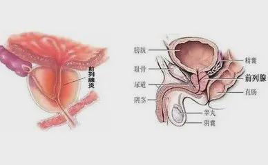 前列腺炎會(huì)伴隨一生嗎？解析前列腺炎的真相與防治策略，解析前列腺炎真相，防治策略與避免伴隨一生的風(fēng)險(xiǎn)