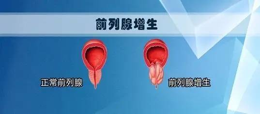 前列腺增生早期怎樣治療好，理解、管理與優(yōu)化，前列腺增生早期治療策略，理解、管理與優(yōu)化之道