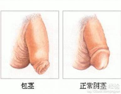 包莖過長(zhǎng)對(duì)身體的影響及應(yīng)對(duì)措施，包莖過長(zhǎng)對(duì)身體的影響與應(yīng)對(duì)措施解析