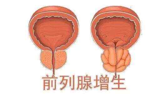 前列腺增生藥物治療效果評估與最佳用藥選擇，前列腺增生藥物治療效果評估及最佳用藥選擇探討